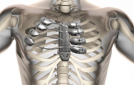 西班牙患者植入全球最复杂3D打印金属胸骨