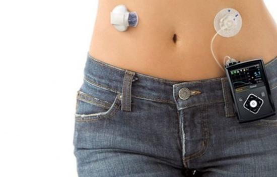 “人工胰脏”曝光 可穿戴在腰间